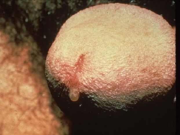 coceira na uretra debido á secreción